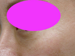 WPRPF 40y lower lid left lateral 1M after-thumb-500x375-1289.jpgのサムネール画像